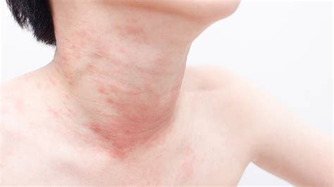 Unusual flu symptoms: Can skin hives be a flu warning sign? - TODAY.com