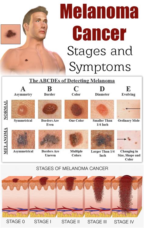 Skin Cancer Signs And Symptoms