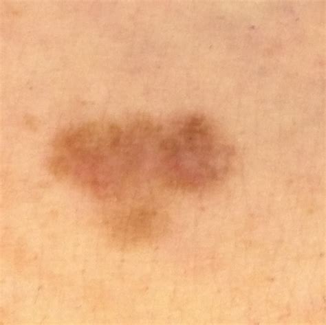 Early Stage Melanoma Pictures