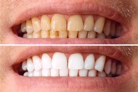 Premium Photo | Teeth before and after whitening. over white background. dental clinic patient ...