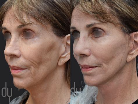 smas facelift before and after photos - smetak-faruolo-99