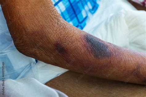 Blood bruises under the skin of an elderly patient Stock Photo | Adobe ...