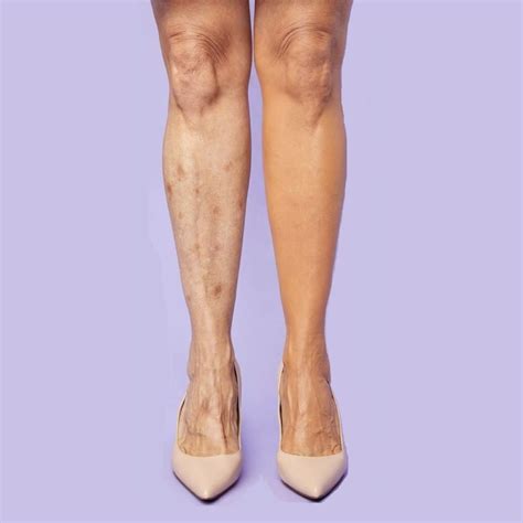 Waterproof Leg Makeup For Scars | Saubhaya Makeup