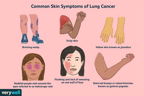 Lung Cancer Symptoms on the Skin to Watch For