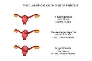 Fibroid Size Classification | USA Fibroid Centers