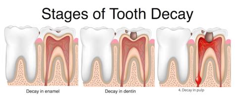 Tooth Decay Causes, Stages and Prevention - My Dentist Burbank