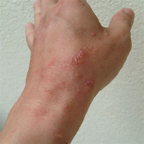 This Plant Is So Much Worse Than Poison Ivy | Poison oak rash pictures, Poison ivy, Poison ivy ...