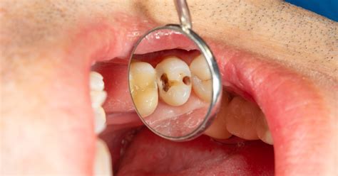 Five Stages of Tooth Decay | Mint Hill Dentistry