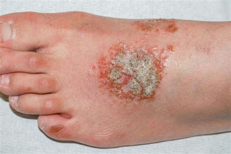 Eczema Blisters: Symptoms, Location, and Treatment