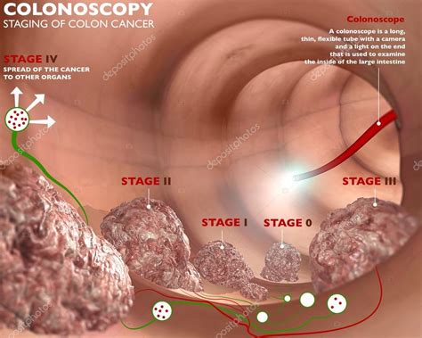 Colonoscopy digestive system — Stock Photo © vampy1 #47042833