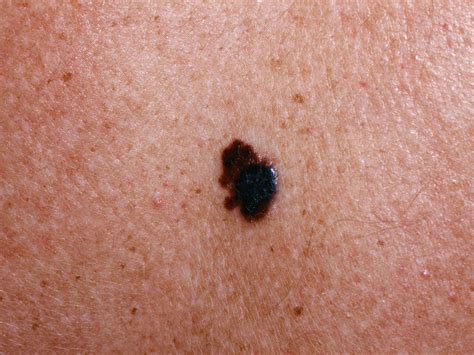 Pictures Melanoma Skin Cancer Moles