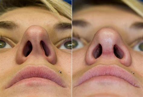 deviated septum nose job before and after - Micki Vincent