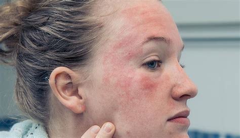 Eczema on Face: Symptoms, Causes, Types & Treatment