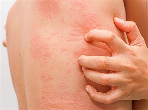 Urticaria: Sus causas, síntomas y relación con enfermedades autoinmunes