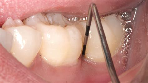 Pocket Reduction Surgery - Sydney City Dentists