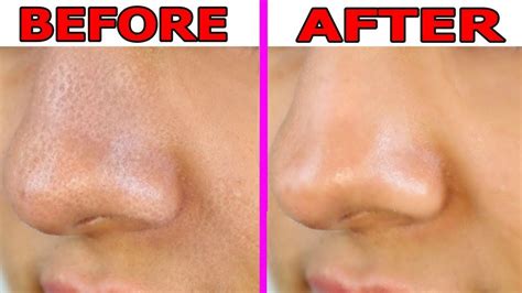 Large Pores Treatment in Dubai - Laser Skin Care Clinic Dubai