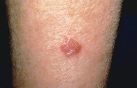 White Spots On Skin Cancer