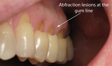 What is the difference between dental attrition, abfraction, erosion ...