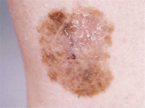 Superficial Spreading Malignant Melanoma