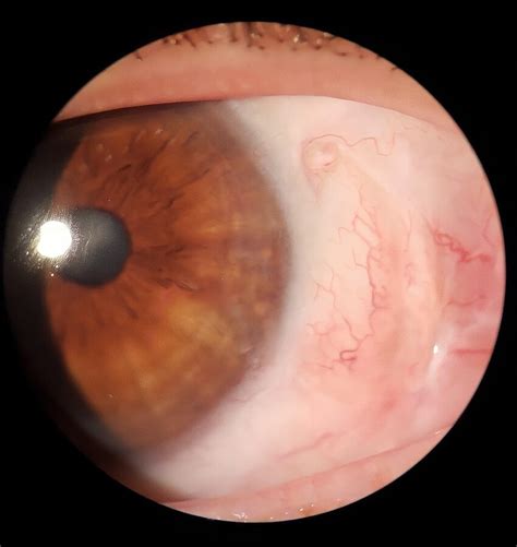 Postoperative Day 30 after pterygium excision with CAG and autologous ...