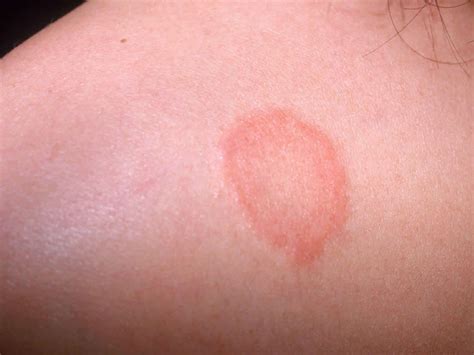 Ringworm, tinea, causes, signs, symptoms, diagnosis & treatment