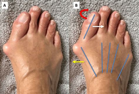 Hallux valgus deformity causes, hallux valgus bunion & treatment