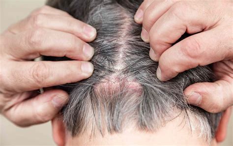 Scabs on Scalp: Causes, Diagnosis, and Treatment