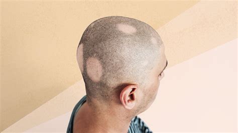 Patchy Hair Loss Alopecia Areata - Infoupdate.org