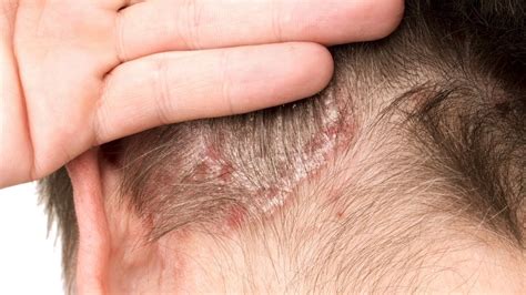 What Is Plaque Scalp Psoriasis Pictures Symptoms Photos Images | Images ...