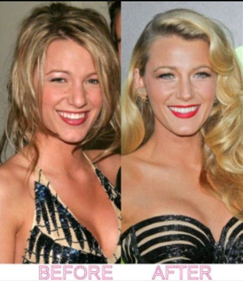 Pin by Montse on Blake Lively&Ryan Reynolds | Blake lively plastic surgery, Blake lively nose ...