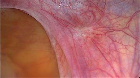 Peritoneal Endometriosis - Indian Center for Endometriosis (ICE)