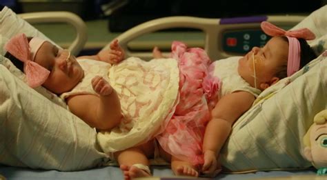 Conjoined Texas twins, Ximena and Scarlett Hernandez-Torres, get set for separation surgery ...