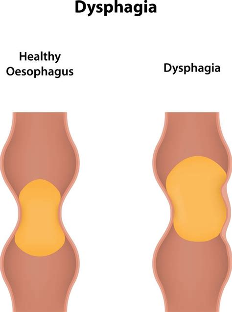 Dysphagia » Palmer General Surgeon | Mat-Su Surgical Associates, A.P.C.