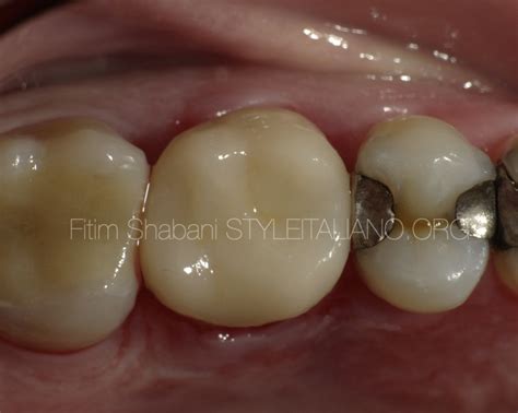 Treatment of a cracked tooth - Style Italiano Endodontics