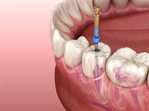 Why is root canal treatment so expensive?