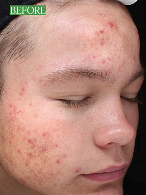 Acne Scar Treatments | Effective Solutions for Acne Scarring | Cedar Grove, NJ — NJ Health Hub