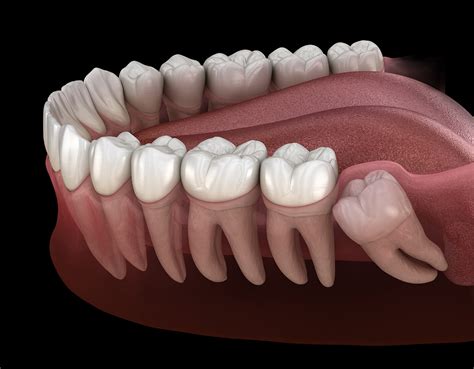 Surgical removal of wisdom teeth Canberra — Canberra Oral & Maxillofacial Centre | Dr Ragu ...