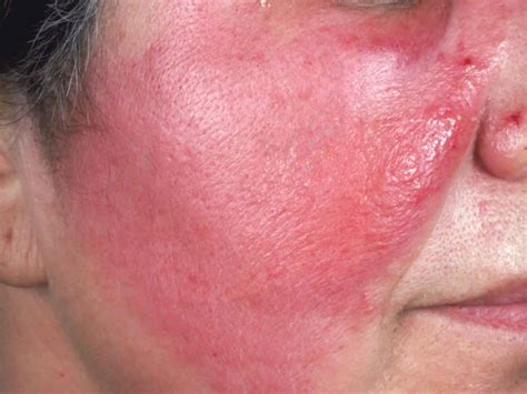 Cellulitis Rash Stages