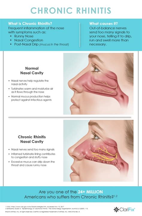 How To Cure A Post Nasal Drip - Apartmentairline8