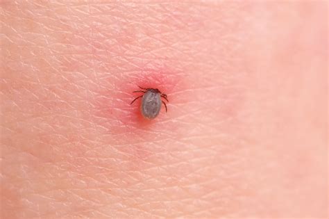 Tick Bite Pictures Symptoms What Does A Tick Bite Look Like? | tunersread.com