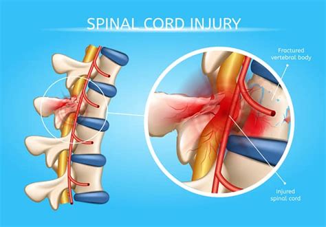 Symptoms and Treatment for a Spinal Cord Injury - Zervos & Calta