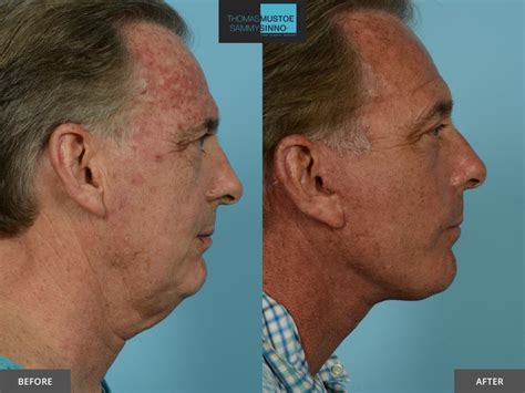 8 Facelift Before-and-After Photos That Prove Just How Natural Today’s Results Look | TLKM ...