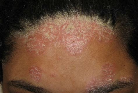 Itchy Rash On Forehead: Causes, Treatment, and Prevention Tips