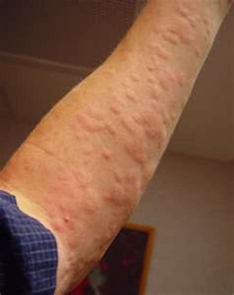 Hives Symptoms, Can Stress Cause Rash and Treatment to Help Allergic Reaction | HubPages