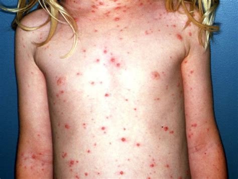 Adult Chicken Pox Stages