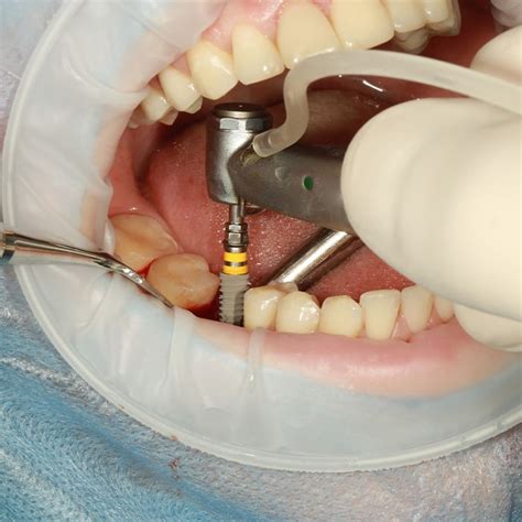 Wisdom Tooth Extraction | What to Expect After Wisdom Tooth Removal