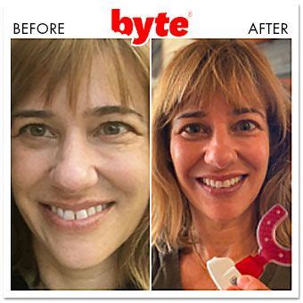 Byte Aligners: 21 Before & After Photos (Pics of Real Results!)