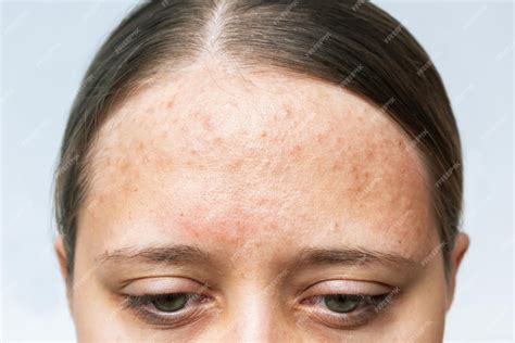 Premium Photo | Close up of red allergic rash on a forehead. Cropped ...