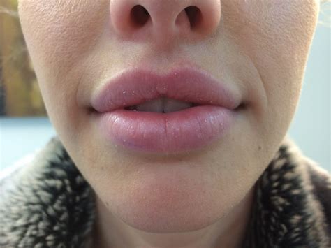 Kissable Lips Made Better With Lip Fillers – Creative Truckee