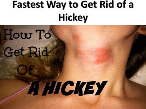 7 fastest way to get rid of a hickey